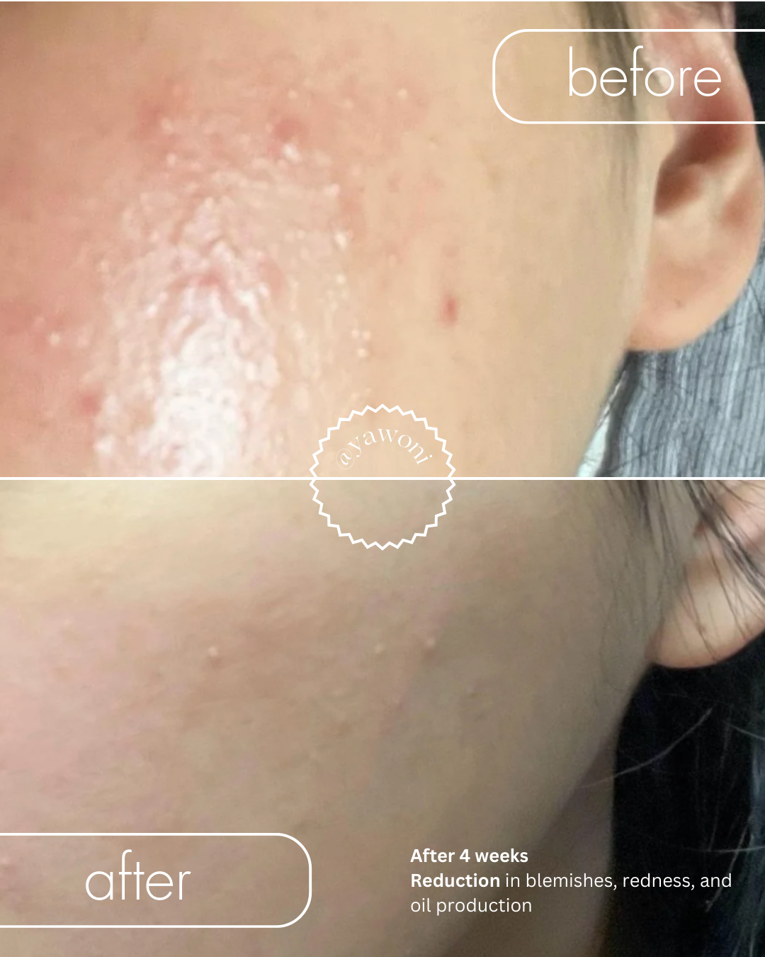 Before and After | Vitamin C & Niacinamide - Yawoni